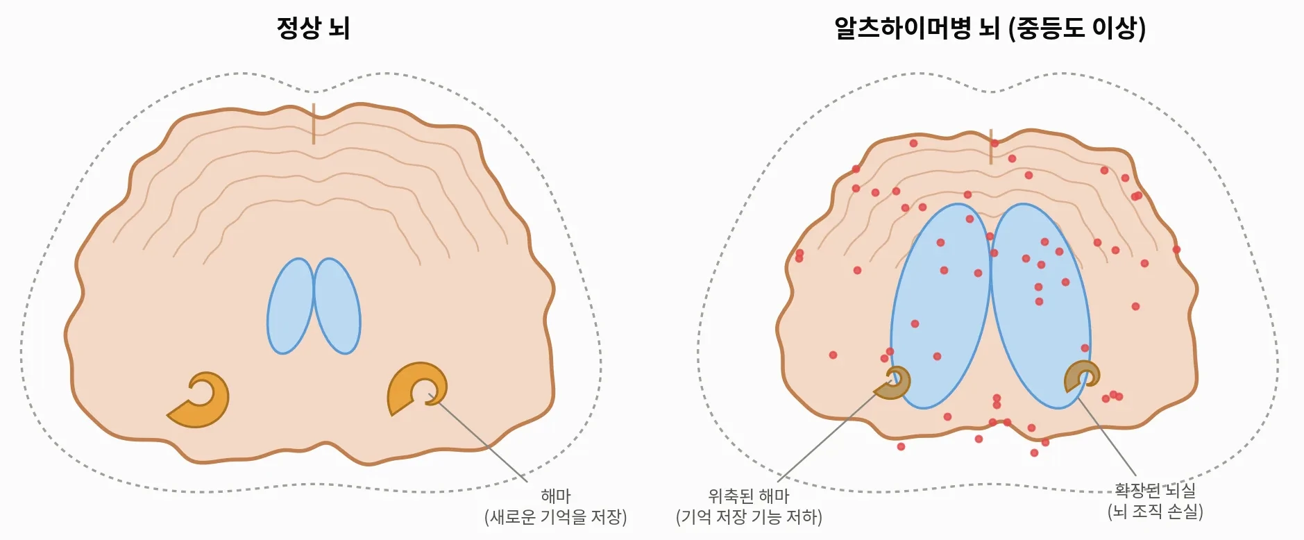 [그림 1] 정상 뇌와 알츠하이머병 뇌 비교 모식도